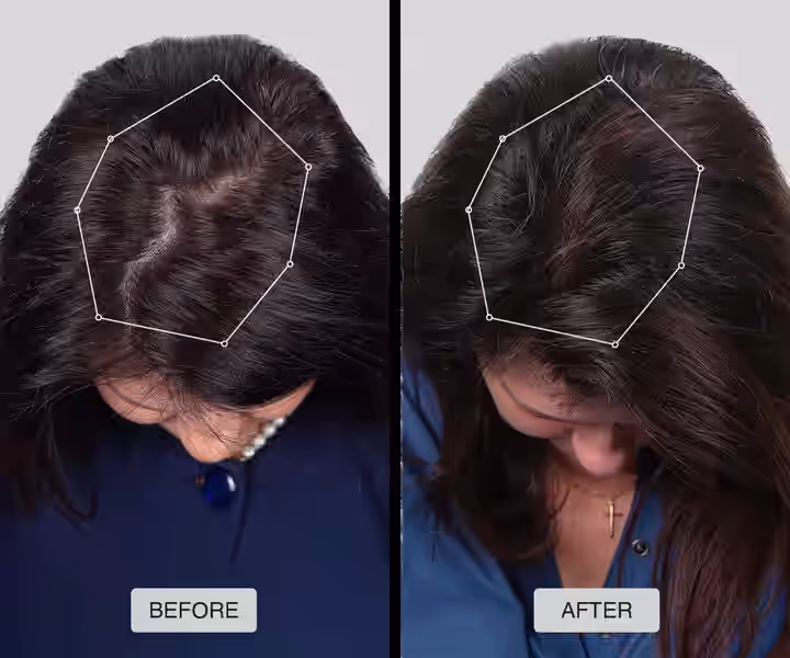 Before and after example of a female patient using a non-surgical hair loss solution