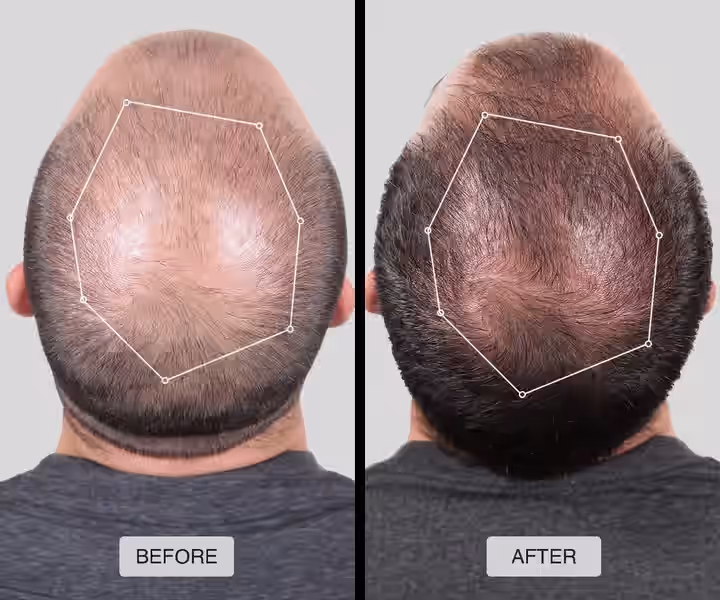 Before and after example of a male patient using a non-surgical hair loss solution