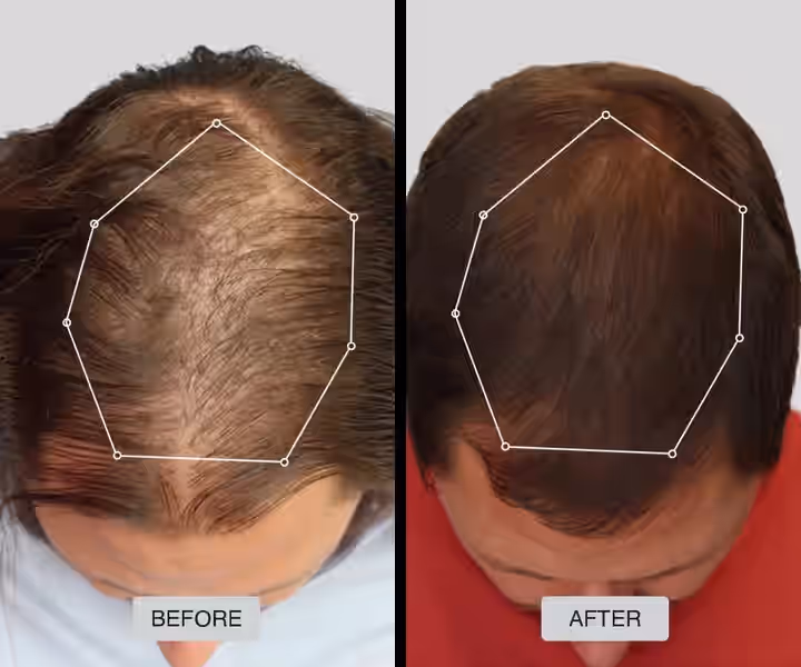 Before and after example of a male patient using a non-surgical hair loss solution